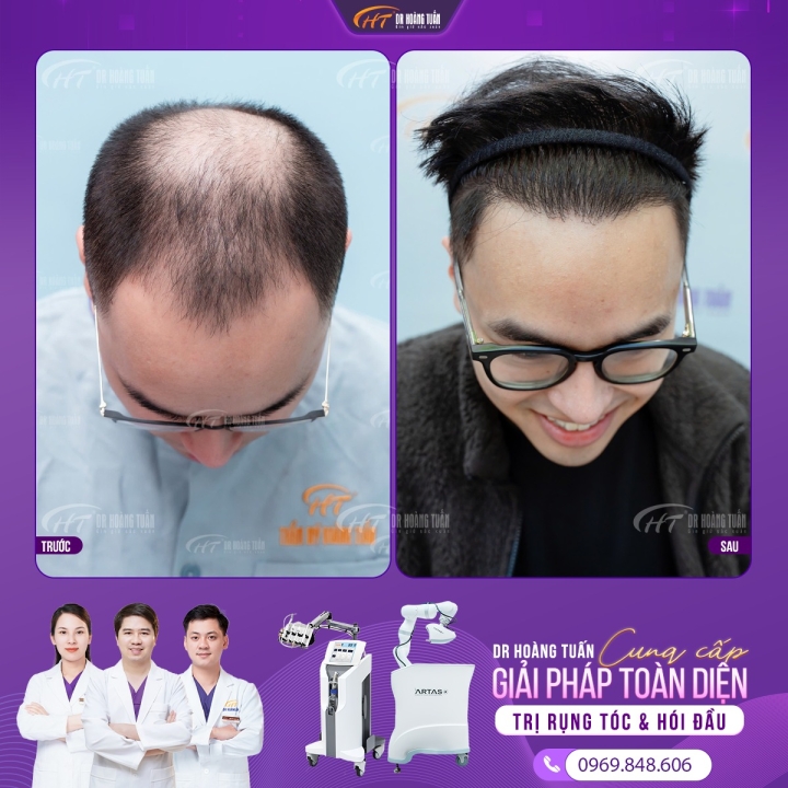 Cấy tóc có bị rụng lại không? Cách hạn chế tóc rụng sau cấy